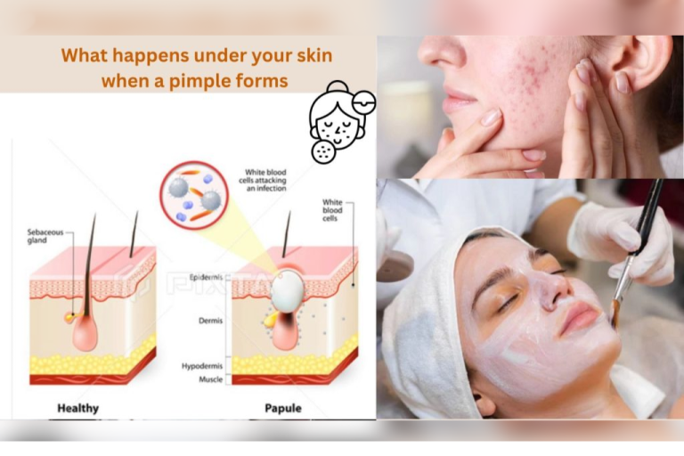 What Happens Under Your Skin When a Pimple Forms?
