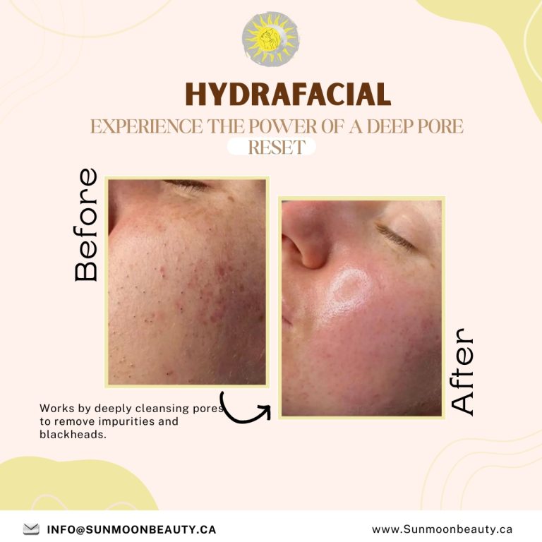 HydraFacial Experience: Visible Transformation & Instant Glow in Ottawa