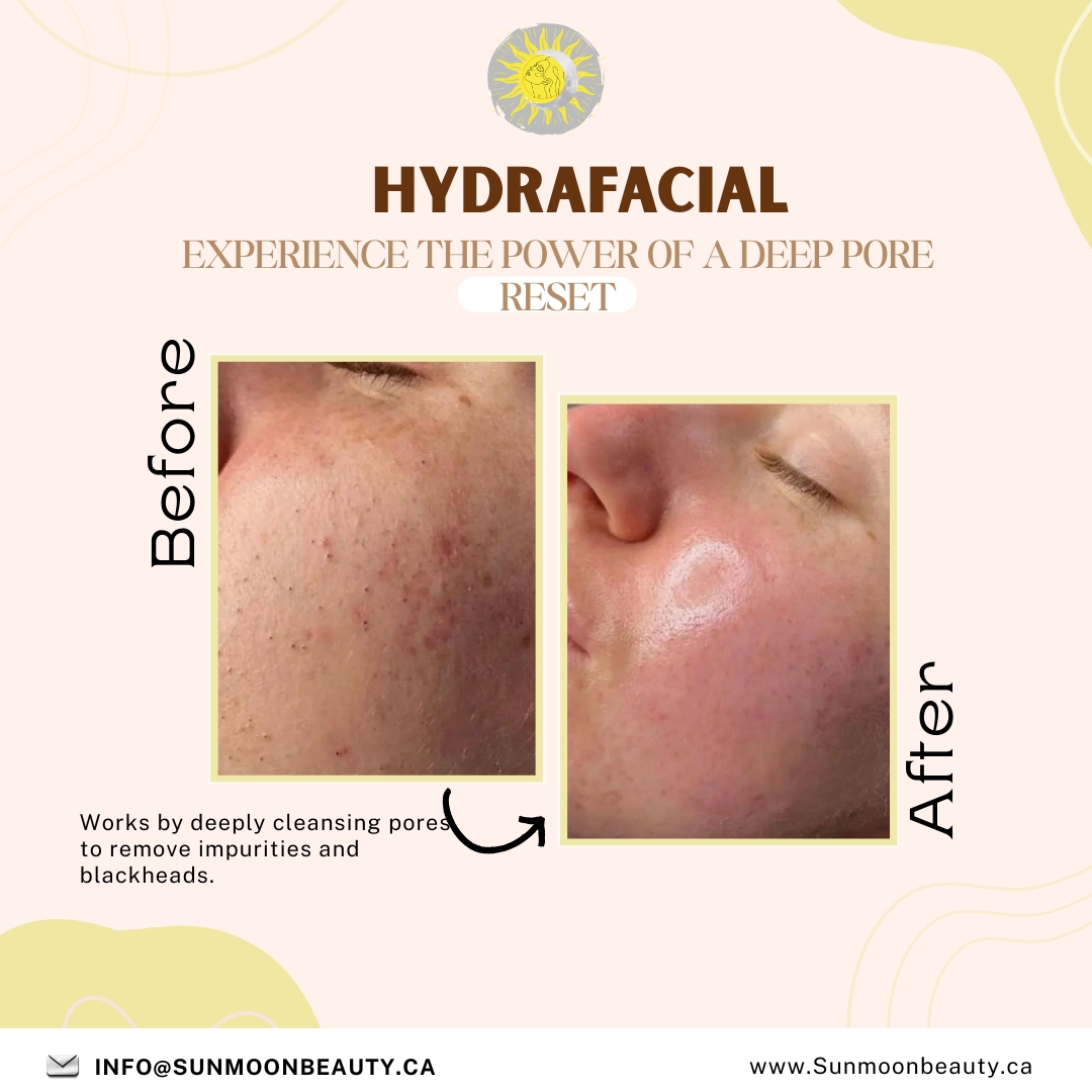 HydraFacial Experience: Visible Transformation & Instant Glow in Ottawa
