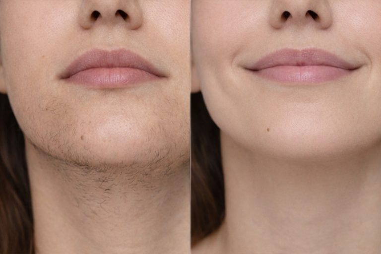 How Much Does Laser Hair Removal Cost in Ottawa