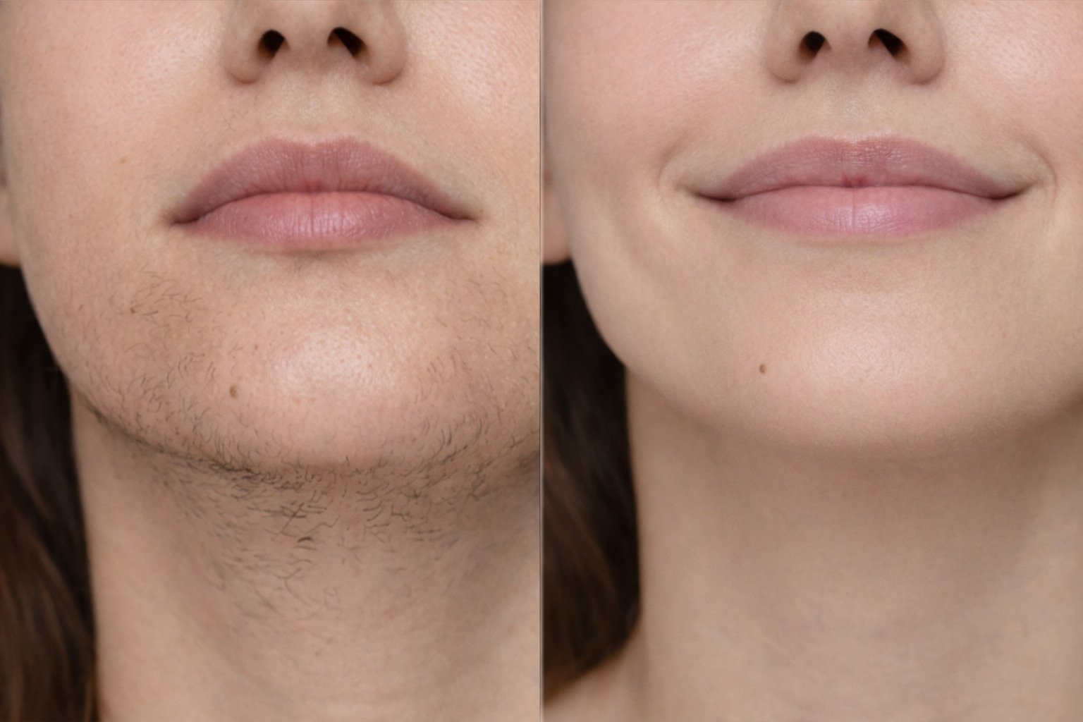 How Much Does Laser Hair Removal Cost in Ottawa?